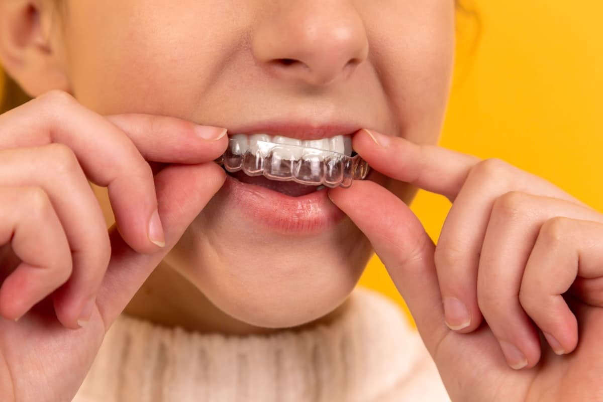 Clear Aligners at Dr. Ruben Aminov DDS